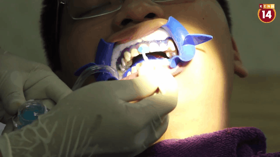 Cận cảnh một ca tẩy trắng răng tại phòng khám và kết quả ngay sau khi hoàn thành - Ảnh 6.