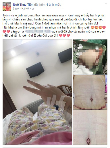 Á quân Bước nhảy ngàn cân khoe ảnh cắt mỡ bụng khiến nhiều người hoảng sợ - Ảnh 1.