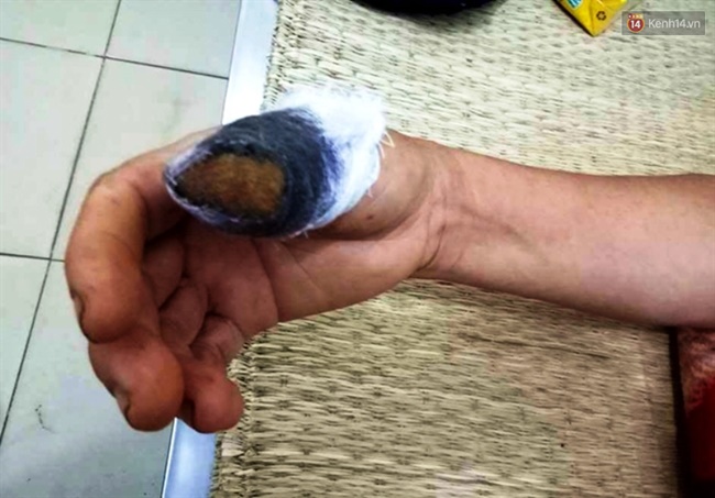 Nghệ An: Cắn đứt ng&oacute;n tay c&aacute;i của h&agrave;ng x&oacute;m v&igrave; d&aacute;m&hellip; h&aacute;i rau kh&ocirc;ng xin ph&eacute;p - Ảnh 2.