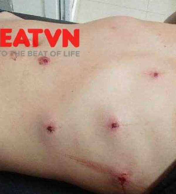 Ninh Bình: Bị người dân truy đuổi, 2 tên trộm chó rút súng hoa cải bắn người đàn ông nhập viện - Ảnh 2.