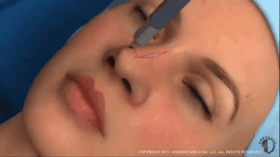 Phẫu thuật nâng mũi đơn giản không mà sao ngày càng nhiều người lựa chọn loại hình làm đẹp này - Ảnh 1.