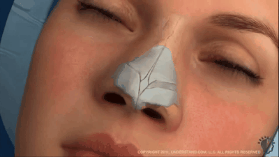 Phẫu thuật nâng mũi đơn giản không mà sao ngày càng nhiều người lựa chọn loại hình làm đẹp này - Ảnh 4.