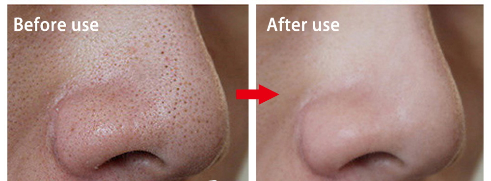 Đ&acirc;y l&agrave; nguy&ecirc;n liệu thần th&aacute;nh khiến con g&aacute;i H&agrave;n kh&ocirc;ng bao giờ lo mụn đầu đen - Ảnh 6.