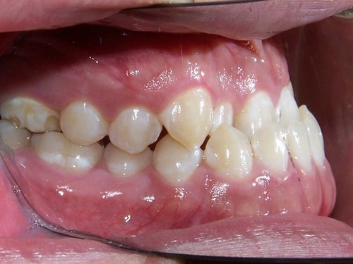 4 trường hợp bắt buộc phải đi niềng răng - Ảnh 6.