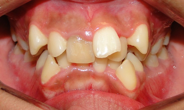4 trường hợp bắt buộc phải đi niềng răng - Ảnh 7.