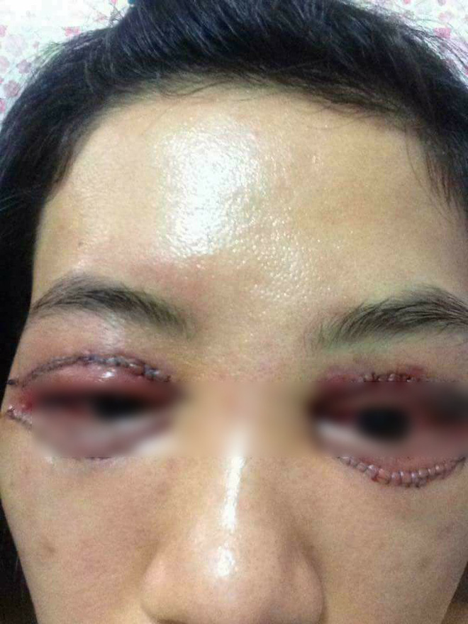 Là tiểu phẫu nhưng cắt mí hay bóc mỡ bọng mắt cũng có thể gây ra những hậu quả nhìn kinh khủng như thế này - Ảnh 7.