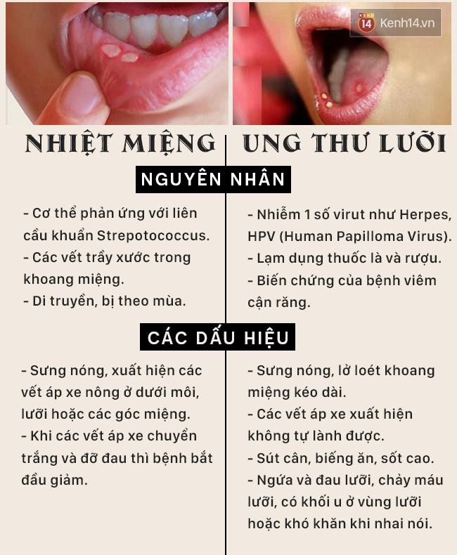 Cẩn thận với các nốt nhiệt miệng bởi có thể đó chính là ung thư lưỡi - Ảnh 2.