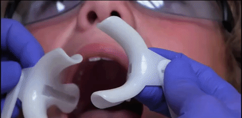 Niềng răng là gì? Quy trình các bước niềng răng để có hàm răng thẳng tắp- Ảnh 1.