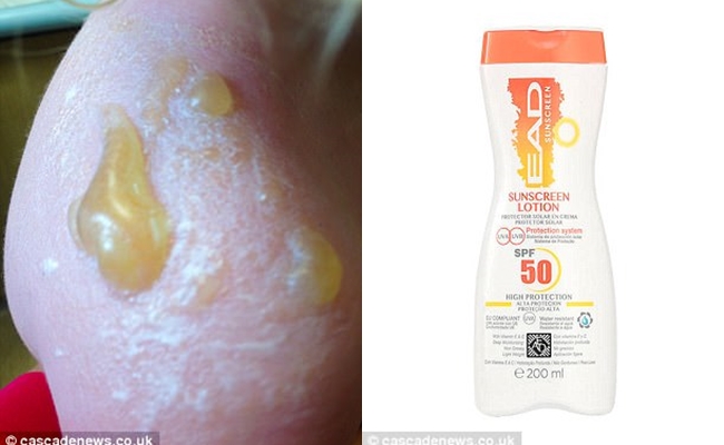 Dùng kem chống nắng SPF 50 đi dã ngoại, bé trai 3 tuổi bị cháy nắng và phồng rộp nghiêm trọng - Ảnh 2.