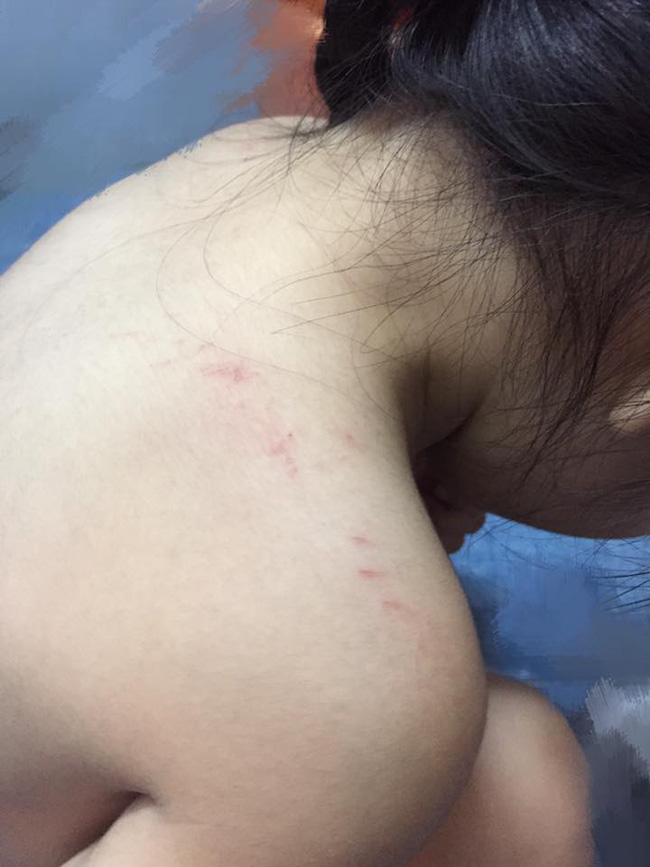 Phụ huynh bức xúc tố cô giáo trường MN quốc tế đánh con gái 3 tuổi trầy xước khắp người - Ảnh 1.