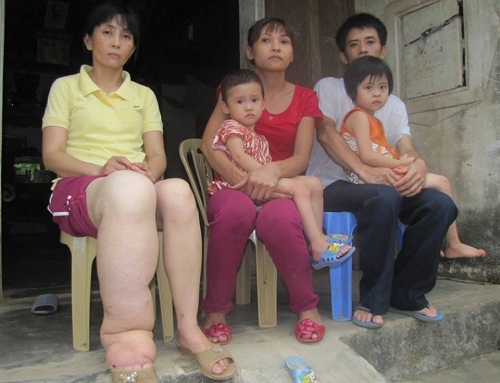 Nỗi đau của gia đình có người mắc bệnh chân voi kỳ lạ ở Nghệ An - Ảnh 2.