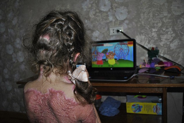 Cảnh báo: Trò chơi trực tuyến khiến bé gái 5 tuổi bị bỏng nặng, toàn thân biến dạng - Ảnh 1.