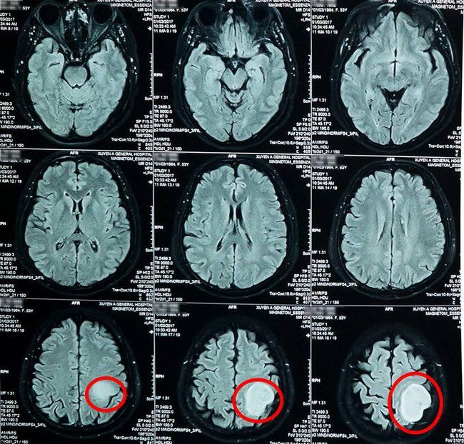 Nhức đầu thường xuyên, người phụ nữ đi khám thì phát hiện khối u não to bằng quả bóng tennis - Ảnh 2.