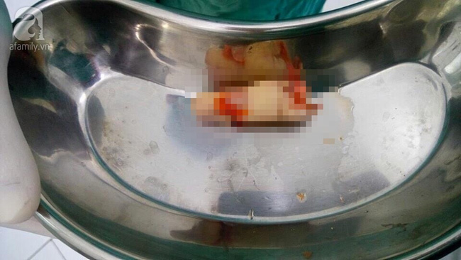 TP.HCM: Một công nhân bị máy xay thịt cắt đứt ngón tay - Ảnh 1.