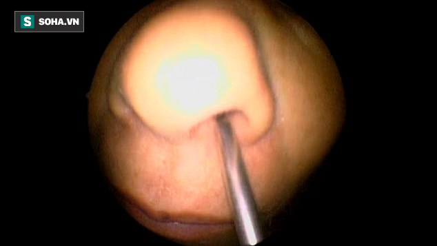 Rửa mặt bằng nước suối, người phụ nữ bị con đỉa dài 8cm làm tổ trong khoang mũi - Ảnh 1. Rửa mặt bằng nước suối, người phụ nữ bị con đỉa dài 8cm làm tổ trong khoang mũi - Ảnh 1.