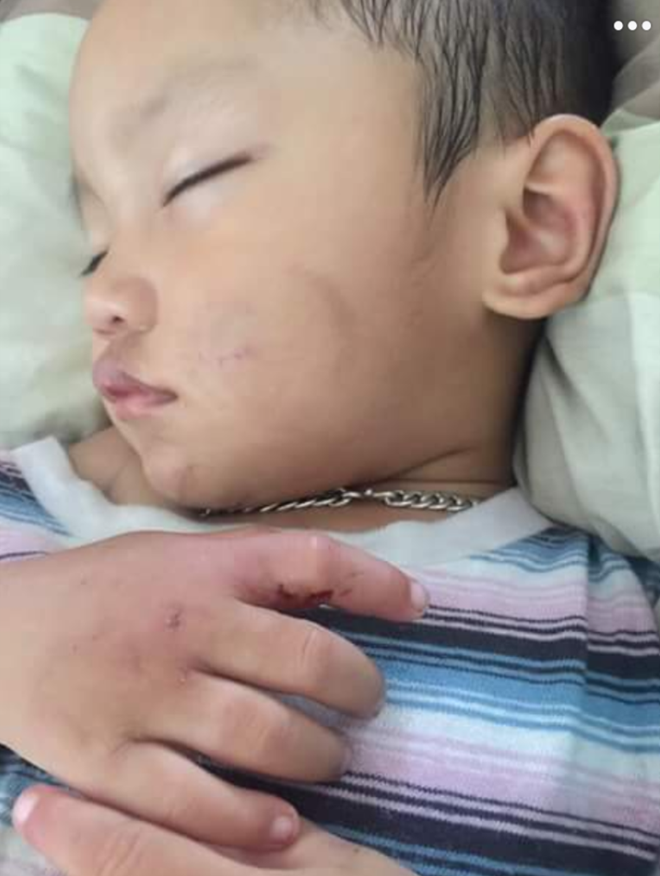 Ch&aacute;u b&eacute; hai tuổi nghi bị bạn trai của mẹ ruột đ&aacute;nh đập - Ảnh 1.