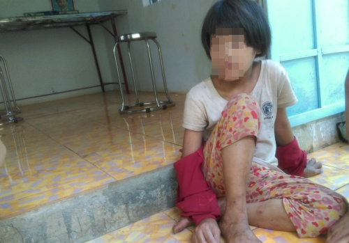 Tương lai mờ mịt của bé gái từng bị mẹ cắt gân chân - Ảnh 1.