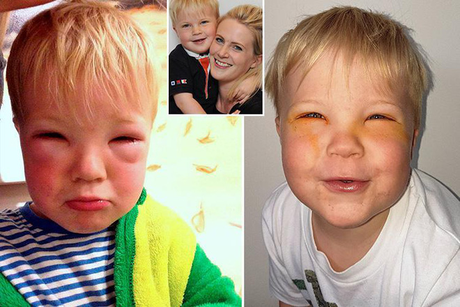 Bé trai 2 tuổi bị mù tạm thời vì mẹ nhuộm tóc - Ảnh 1.