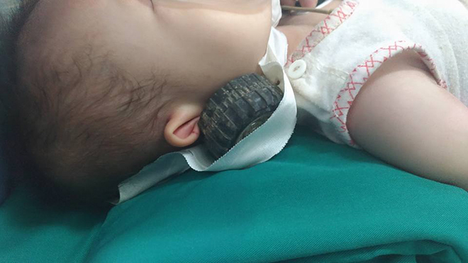 Kinh hãi hình ảnh bánh xe đồ chơi nhọn cắm sâu vào đầu bé gái 11 tháng tuổi - Ảnh 2.