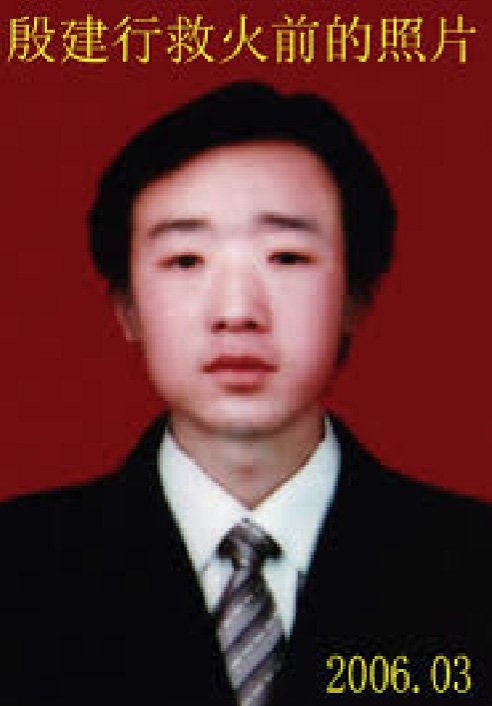 Cuộc sống phi thường của ch&agrave;ng trai bị biến dạng v&igrave; cứu 13 mạng người - Ảnh 1.