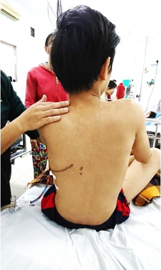 Chọc ghẹo bạn, bé trai 14 tuổi bị phóng kéo vào lưng xuyên thấu ngực - Ảnh 1.