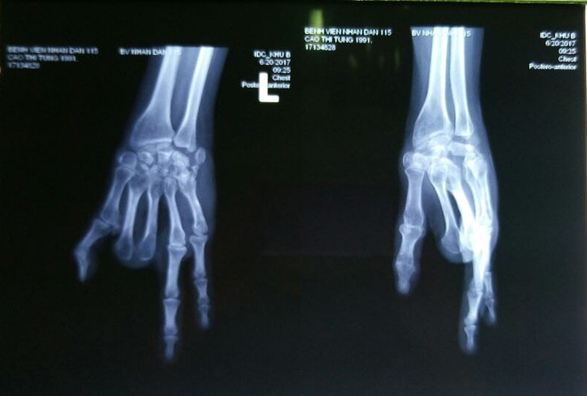 Sau 7 năm, cô gái 26 tuổi tìm lại hai ngón tay đã mất từ… bàn chân - Ảnh 1.