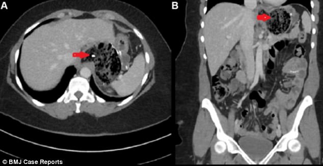 Vì thói quen kì quái, người phụ nữ khiến bác sĩ sốc khi lấy ra vật này trong dạ dày - Ảnh 1.
