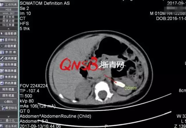 Bé trai 10 tháng tuổi bị sỏi thận do bố mẹ lười thay bỉm cho con - Ảnh 1.