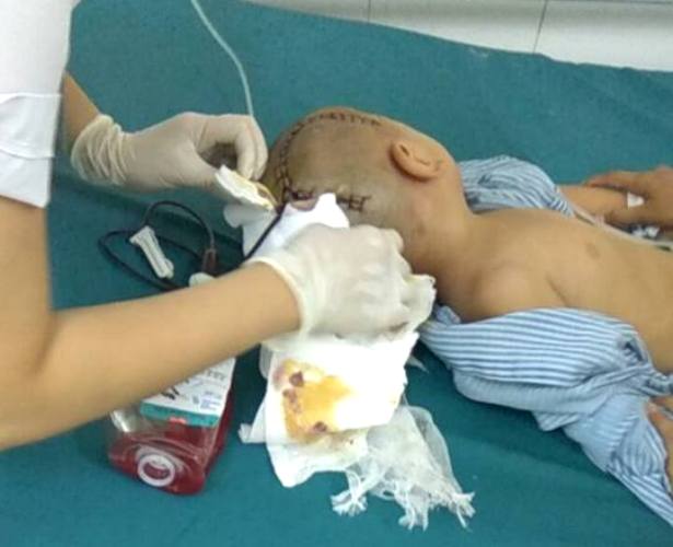 Thái Bình: Bé trai 3 tuổi đi học ở trường mầm non bị tụ máu 1/4 não phải mổ cấp cứu - Ảnh 1.