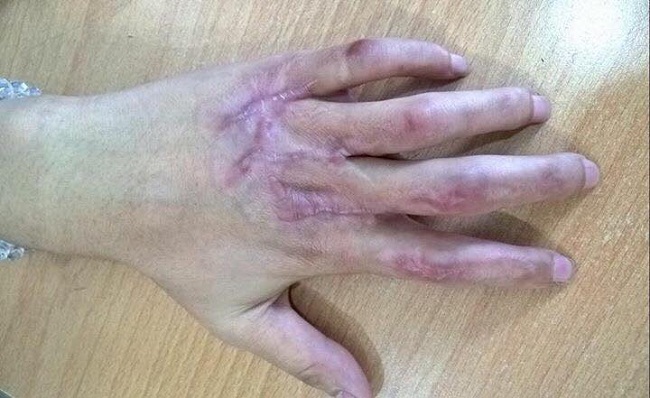 Niềm vui của c&ocirc; g&aacute;i trẻ c&oacute; b&agrave;n tay được t&aacute;i sinh sau 2 năm đau đớn - Ảnh 2.