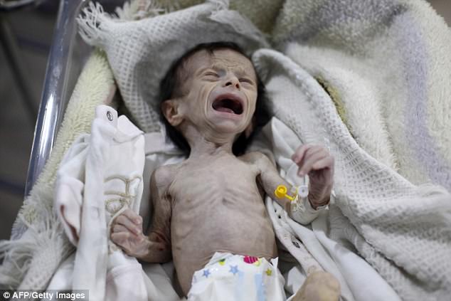 Hình ảnh em bé Syria suy dinh dưỡng, gầy trơ xương khiến cả thế giới rúng động - Ảnh 1.