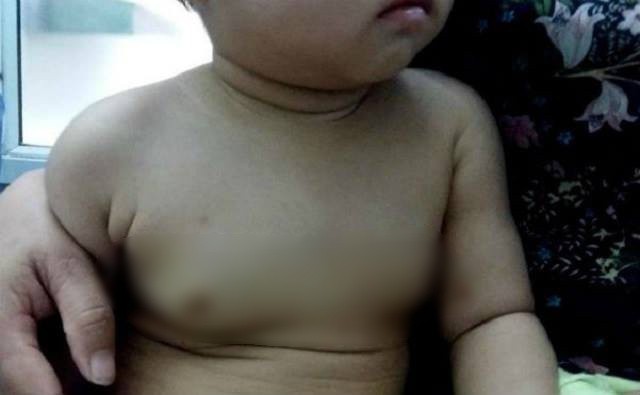 Bé gái 22 tháng tuổi có tuyến vú phát triển lớn, bác sĩ nghi do mẹ uống thuốc tránh thai trong khi cho con bú - Ảnh 1.