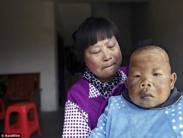 Sinh ra đứa trẻ quái dị, người đời xui vứt con đi nhưng bà mẹ vẫn một mình nuôi nấng suốt 30 năm - Ảnh 2.