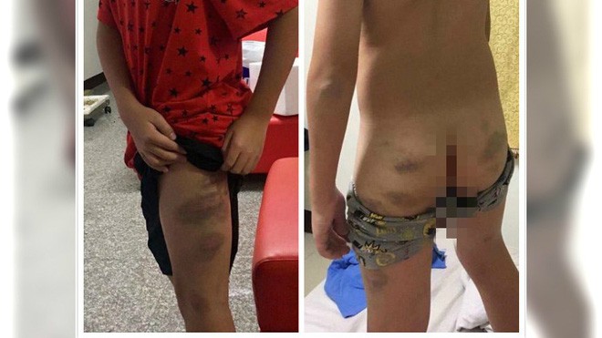 Thi kh&ocirc;ng đạt 95 điểm, b&eacute; trai bị mẹ đ&aacute;nh đập d&atilde; man khiến to&agrave;n th&acirc;n bầm t&iacute;m - Ảnh 1.
