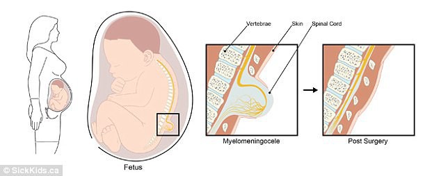 Thai nhi chưa ra đời, bác sĩ đã mổ tử cung mẹ để phẫu thuật, kết quả khiến mẹ mừng khôn xiết - Ảnh 2.