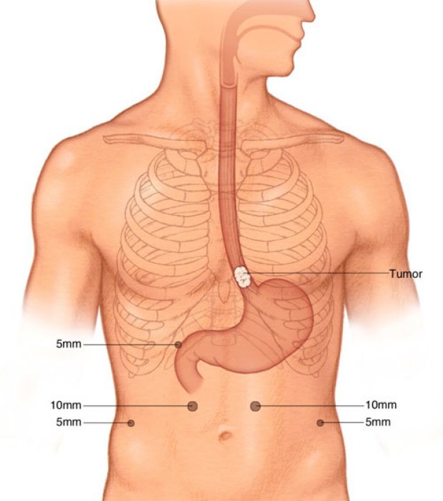 Chỉ vì lười thực hiện 1 thói quen hàng ngày này mà bạn có thể bị ung thư thực quản - Ảnh 2.