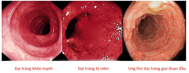 80% người ph&aacute;t hiện mắc ung thư đại tr&agrave;ng ở giai đoạn cuối chỉ v&igrave; kh&ocirc;ng l&agrave;m việc n&agrave;y sớm - Ảnh 3.