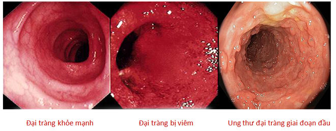 80% người phát hiện mắc ung thư đại tràng ở giai đoạn cuối chỉ vì không làm việc này sớm - Ảnh 3.