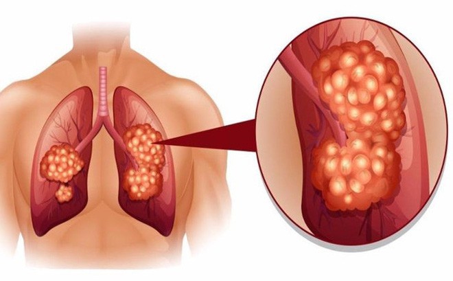 Dấu hiệu lặng lẽ của bệnh ung thư phổi không ai được xem thường - Ảnh 1.