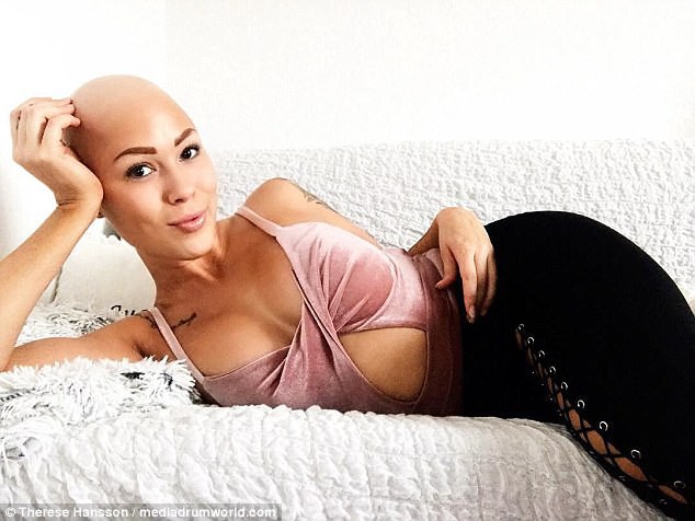 Tưởng mình bị ung thư khi tóc rụng dần, 12 năm sau, cô trở thành một người mẫu xinh đẹp với chiếc đầu trọc lóc - Ảnh 1.