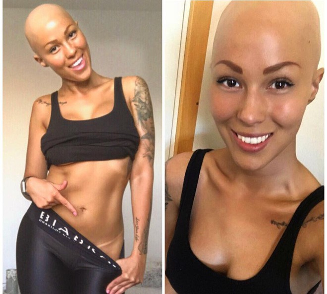 Tưởng mình bị ung thư khi tóc rụng dần, 12 năm sau, cô trở thành một người mẫu xinh đẹp với chiếc đầu trọc lóc - Ảnh 2.