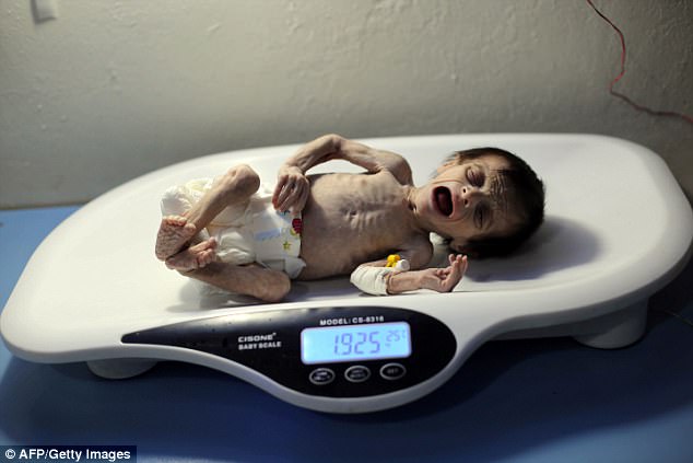Hình ảnh em bé Syria suy dinh dưỡng, gầy trơ xương khiến cả thế giới rúng động - Ảnh 5.