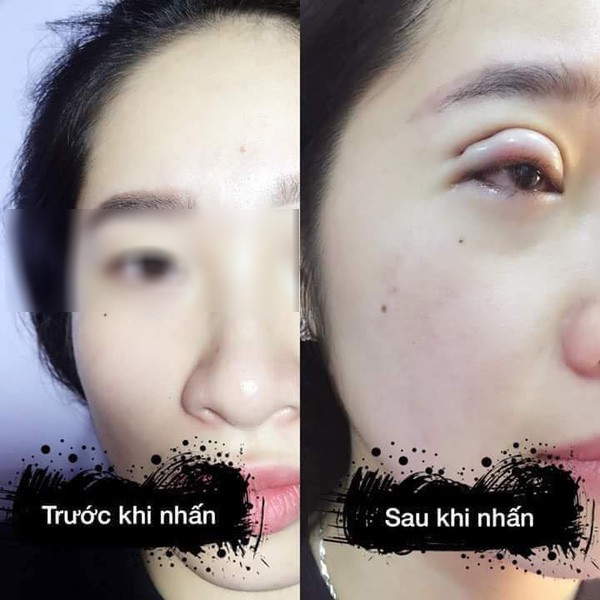 Là tiểu phẫu nhưng cắt mí hay bóc mỡ bọng mắt cũng có thể gây ra những hậu quả nhìn kinh khủng như thế này - Ảnh 14.