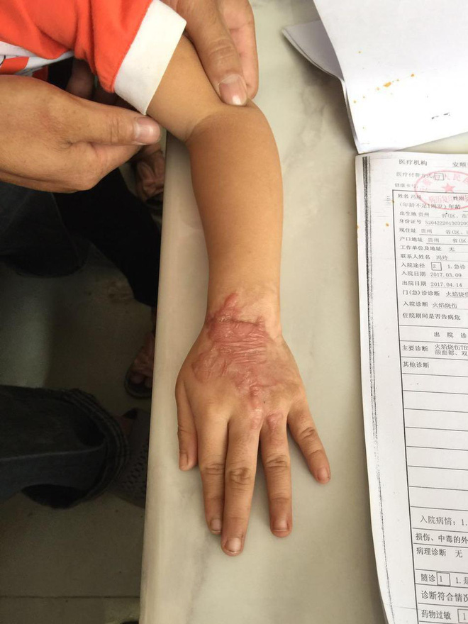 B&eacute; g&aacute;i 5 tuổi bị bỏng v&igrave; điện thoại ph&aacute;t nổ trong l&uacute;c ngủ, c&ocirc;ng ty điện thoại phớt lờ - Ảnh 3.