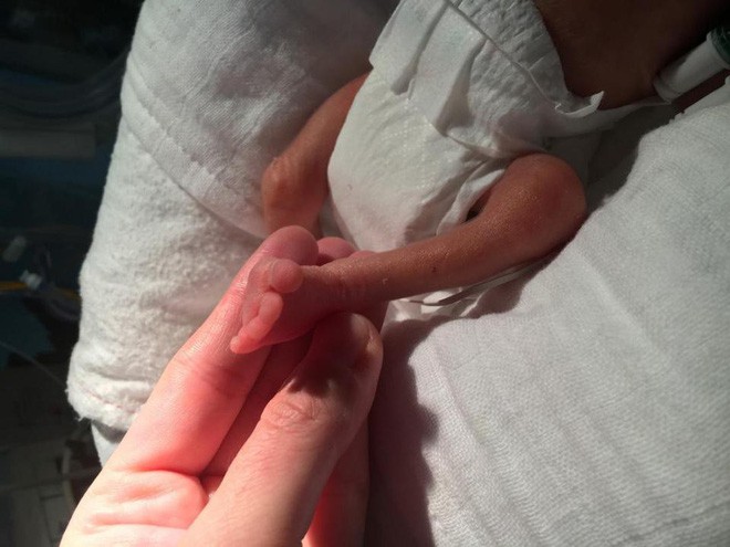 Đẻ non khi mới 23 tuần tuổi, cậu b&eacute; nặng chưa đầy nửa kg vẫn sống s&oacute;t thần kỳ - Ảnh 3.
