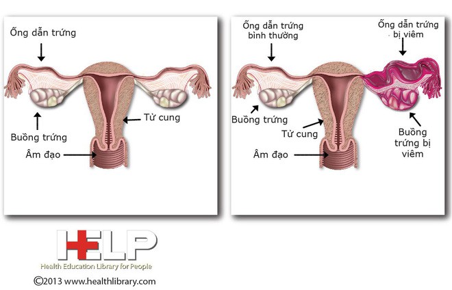 Căn bệnh nhiễm trùng không có triệu chứng rõ ràng này hoàn toàn có thể khiến bạn bị vô sinh - Ảnh 3.