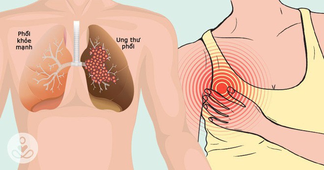 Dấu hiệu lặng lẽ của bệnh ung thư phổi không ai được xem thường - Ảnh 3.