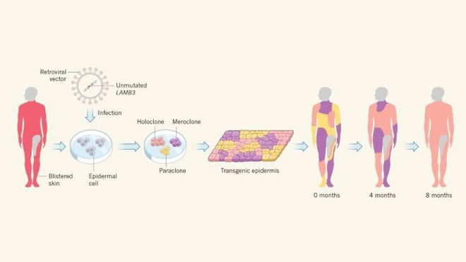Lần đầu tiên trong lịch sử, các nhà khoa học thay thế 80% bộ da một người bằng da chỉnh sửa gen - Ảnh 4.