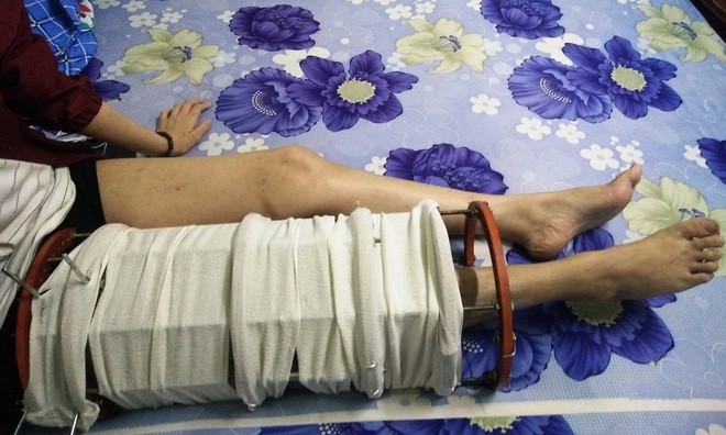 Mẹ vừa mới mất, người cha đau đớn nh&igrave;n con g&aacute;i 15 tuổi mắc bệnh ung thư xương &aacute;c t&iacute;nh m&agrave; kh&ocirc;ng tiền chữa trị - Ảnh 4.