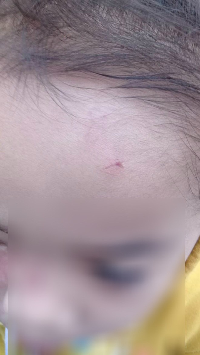 Bé gái 4 tuổi bị bạo hành ở Mầm Xanh tiếp tục có dấu hiệu bị đánh đập ở cơ sở giữ trẻ mới - Ảnh 4.